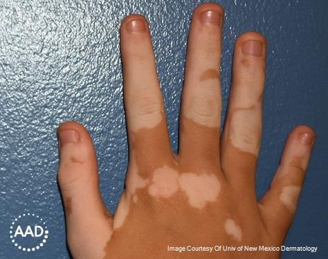 Vitiligo on brown skin